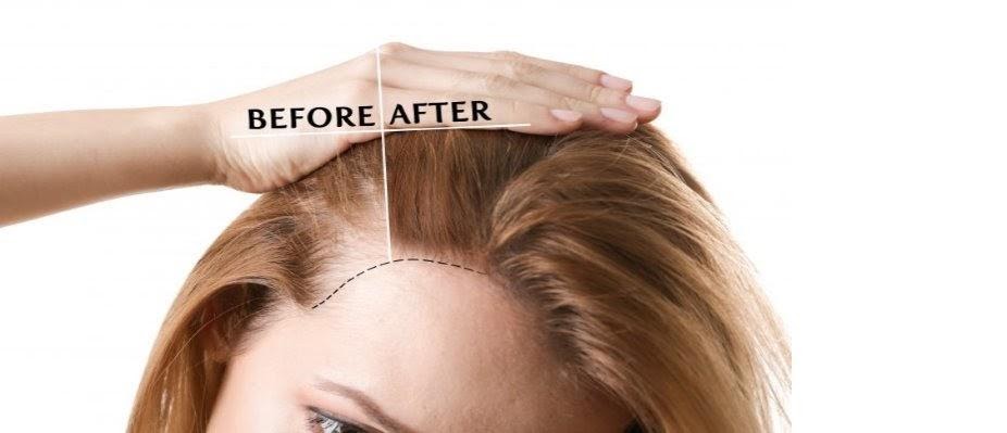 What to Expect After Hair Transplant in Jaipur?